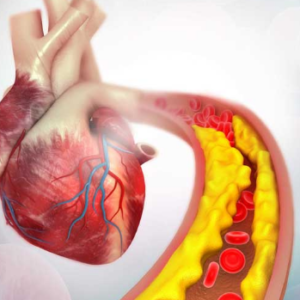 Cholestrol Management